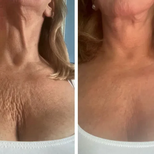 ultherapy-before-after
