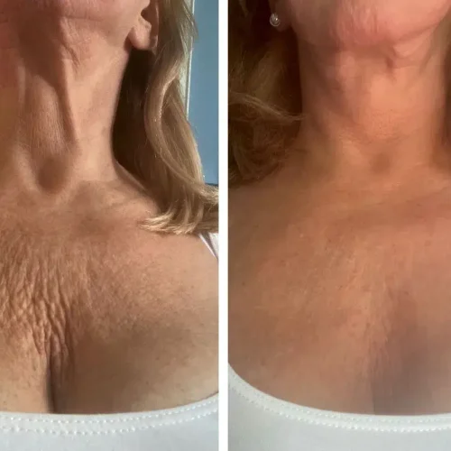 ultherapy-before-after